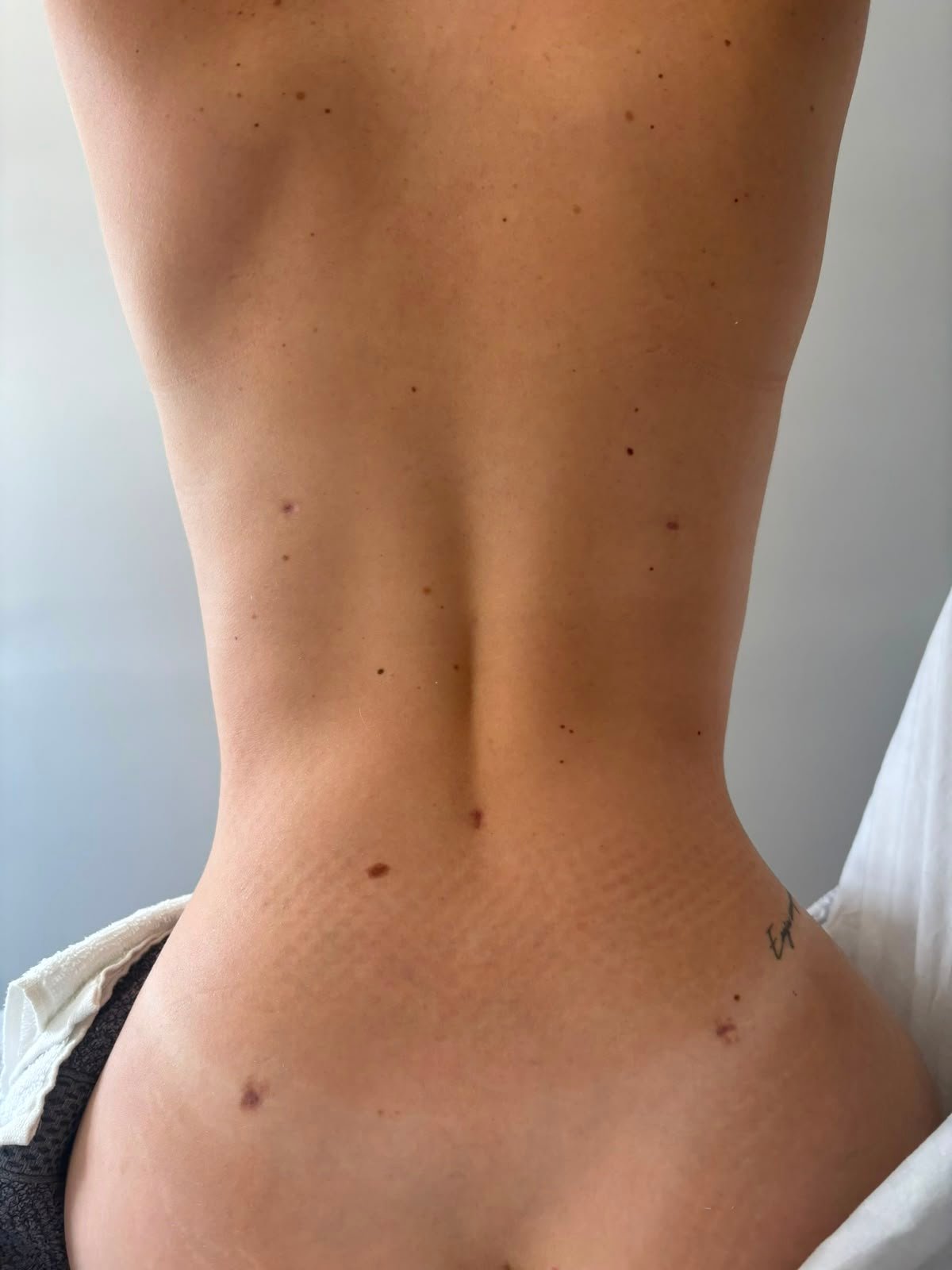 Pos Operatorio em Itu Lipoescultura depois