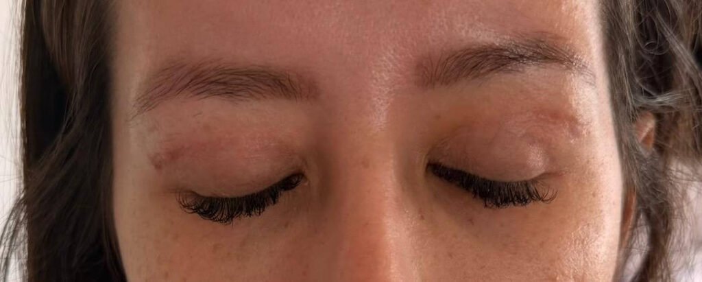 Cicatriz da blefaroplastia superior em fase de cicatrização, com as pálpebras fechadas