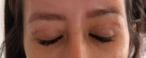 Cicatriz da blefaroplastia superior em fase de cicatrização, com as pálpebras fechadas