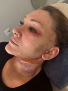 Pós-operatório de reestruturação facial acompanhado em Itu