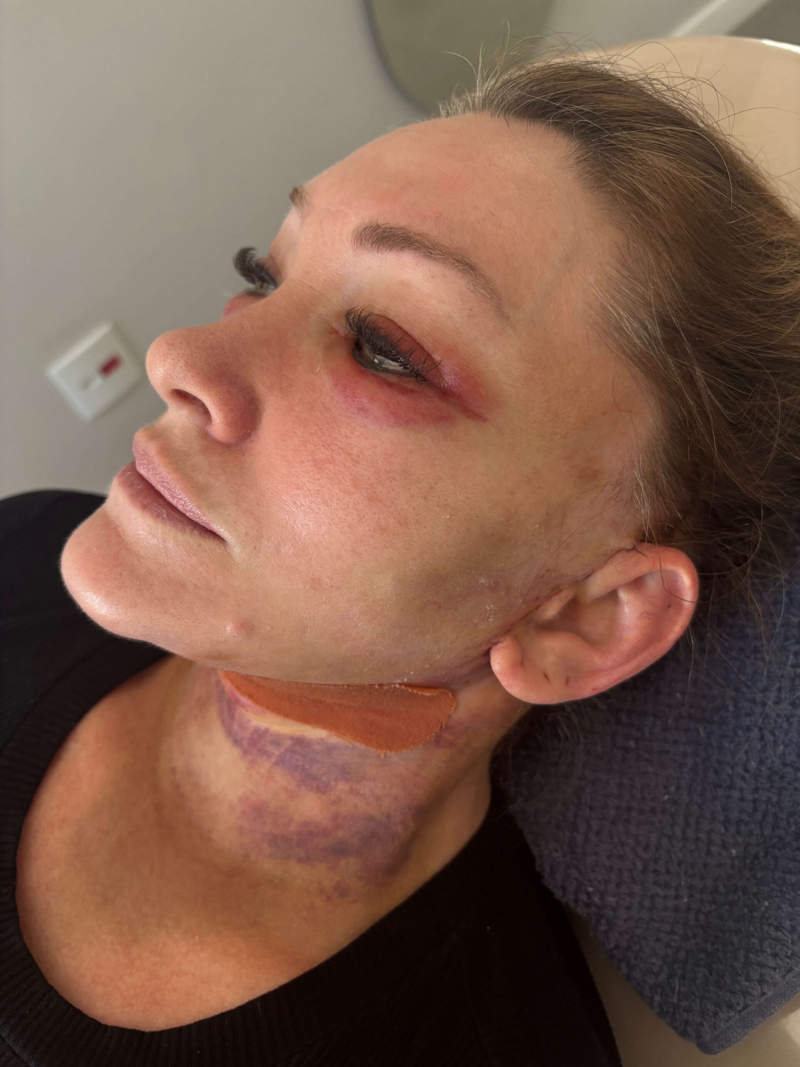 Pós-Operatório em Itu com andressa costa pos de reestruturação facial-antes