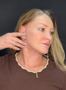 Evolução do pós-operatório de reestruturação facial