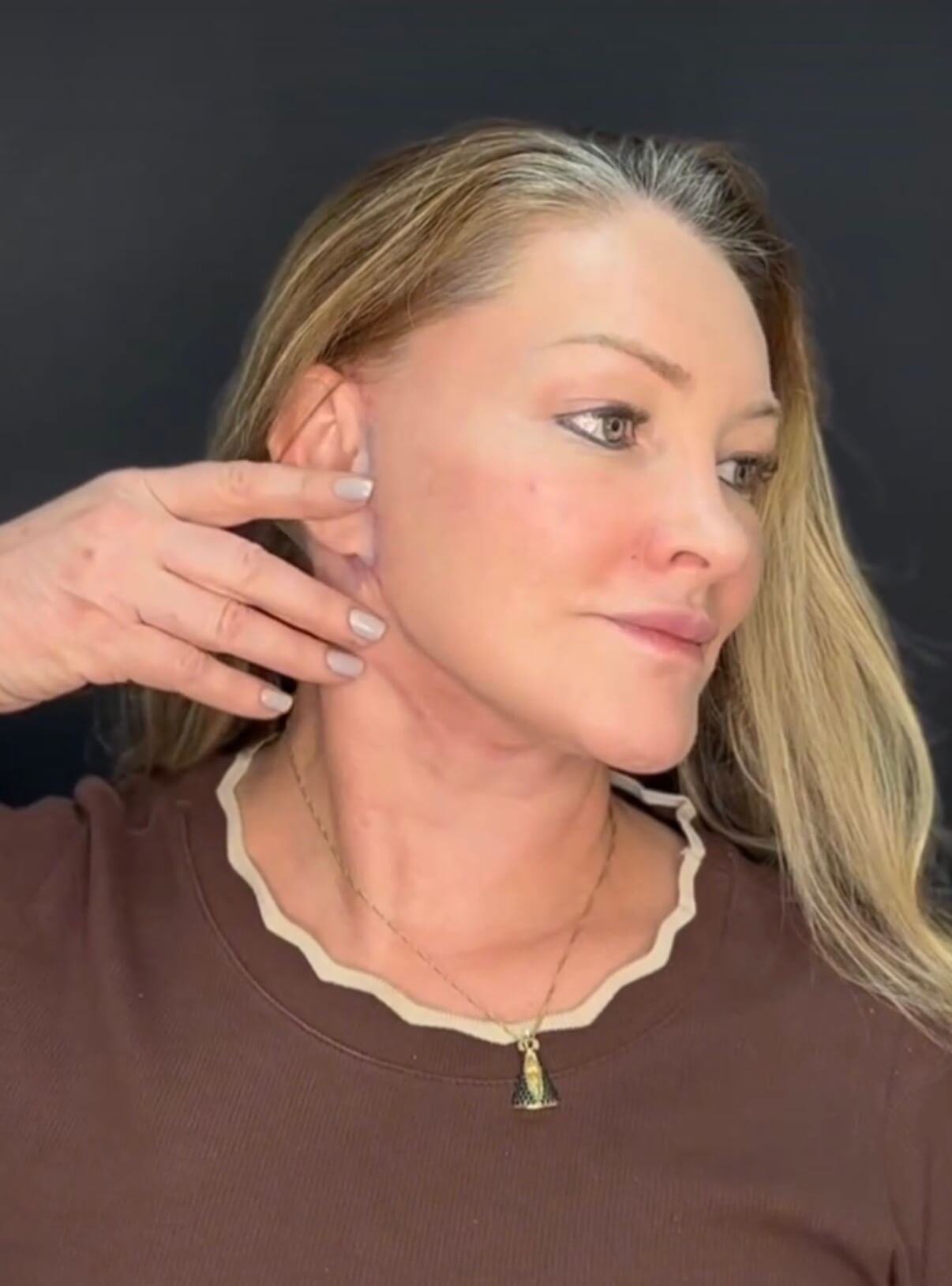 Pós-Operatório em Itu com andressa costa pos de reestruturação facial-depois