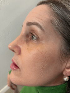 Evolução da recuperação após rinoplastia