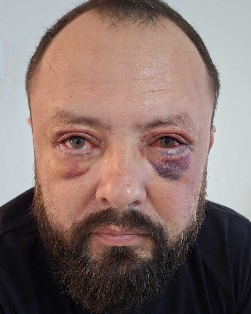Pós-operatório imediato de blefaroplastia inferior com hematomas roxos sob os dois olhos e ponto visível