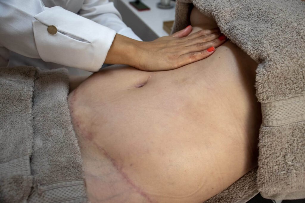 Região abdominal em recuperação após abdominoplastia, acompanhada em Itu