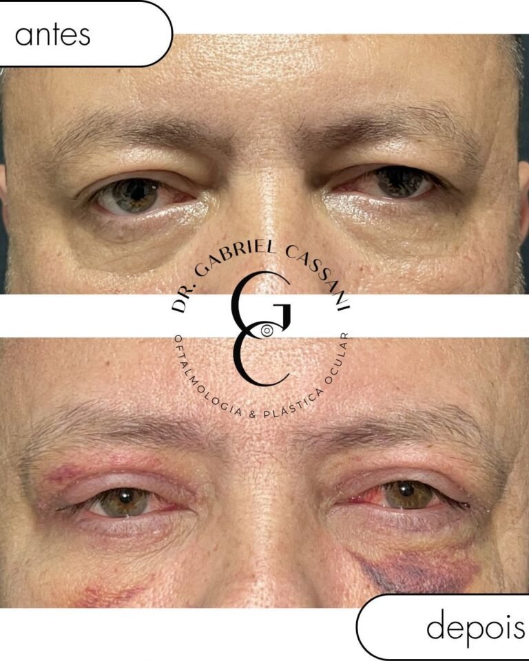 Pós-operatório de blefaroplastia superior acompanhado em Itu