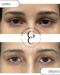 Recuperação de blefaroplastia acompanhada em Itu por Andressa Costa