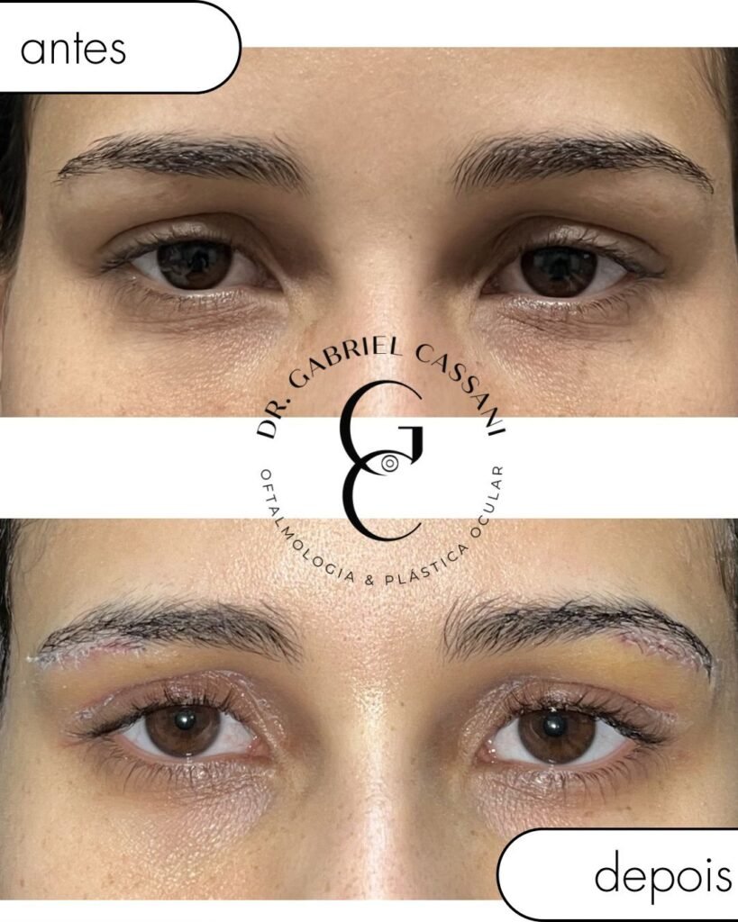 Recuperação de blefaroplastia acompanhada em Itu por Andressa Costa