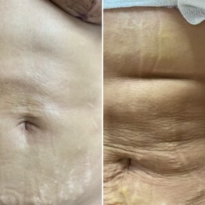 Evolução de área fibrosada após sessões de tratamento em Itu