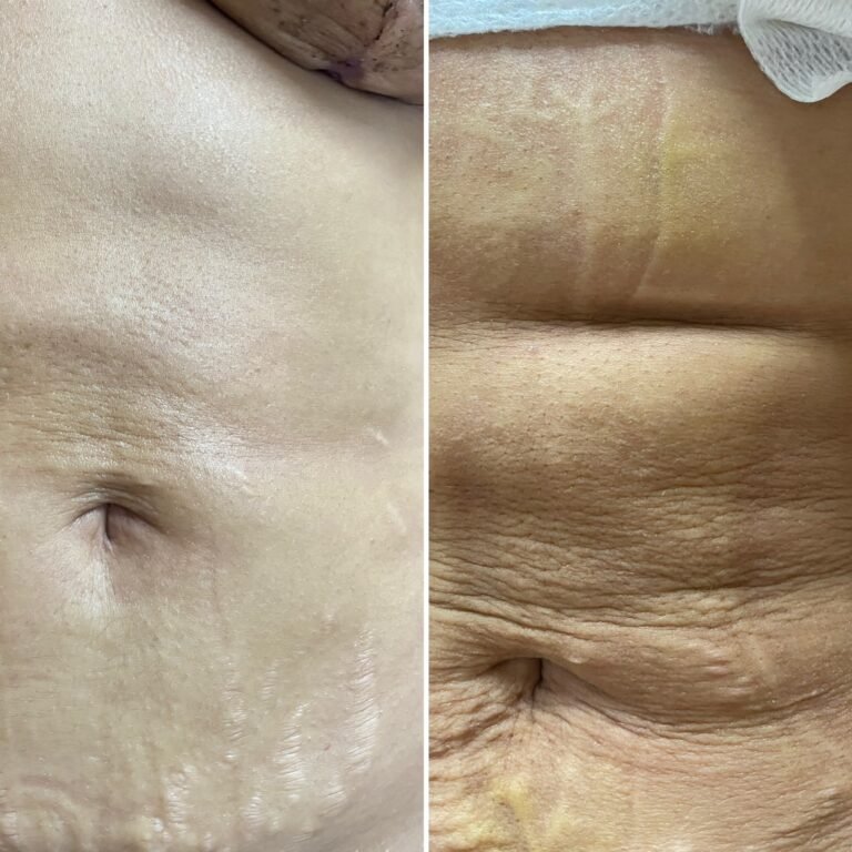 Evolução de área fibrosada após sessões de tratamento em Itu