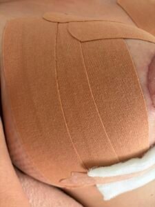 Bandagem elástica aplicada em leque sobre a área operada para reduzir edema no pós-operatório