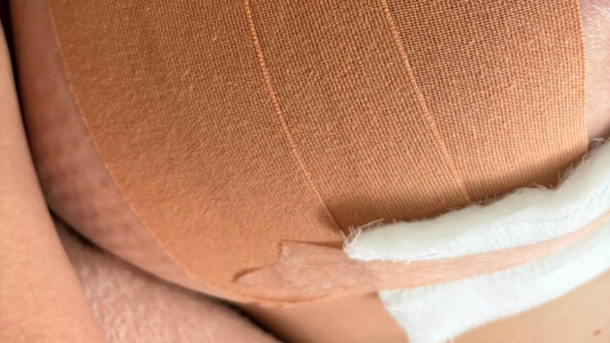Bandagem elástica aplicada em leque sobre a área operada para reduzir edema no pós-operatório