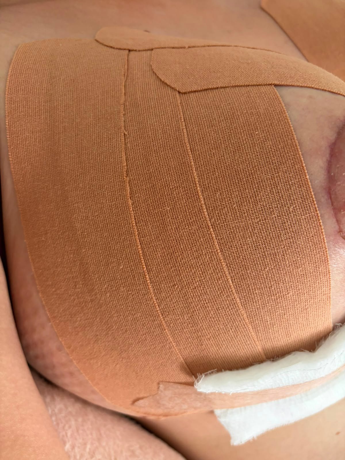 Bandagem elástica aplicada em leque sobre a área operada para reduzir edema no pós-operatório