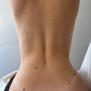 Evolução do pós-operatório de lipoescultura acompanhada em Itu