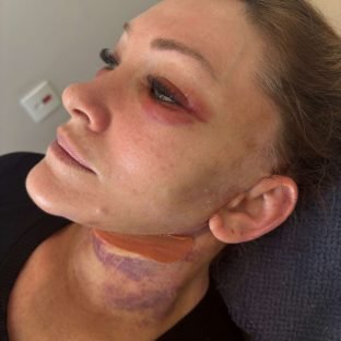 Pós-operatório de reestruturação facial acompanhado em Itu