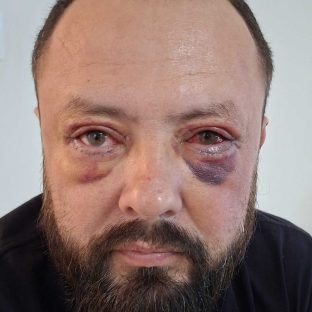 Pós-operatório imediato de blefaroplastia inferior com hematomas roxos sob os dois olhos